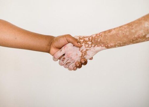 Handshake showing support between a person with vitiligo and another, symbolizing inclusive care at Cutis Institute in Calicut, Kerala—a leading skin hospital and aesthetic clinic offering advanced dermatology services including vitiligo treatment, melanocyte transplantation, acne and burn scar care, Botox, face lift, PRP, GFC, keloid treatment, pigmentation correction, trichology, hair transplant, peels, laser therapies (Ultra Plus, Excimer, Carbon, Plus dye), Exosome therapy, regenerative medicine, and consultations with expert dermatologists like Dr. Salim, Dr. Prasannakumar, Dr. Laila, Dr. Hafiz, and Dr. Kadhar.